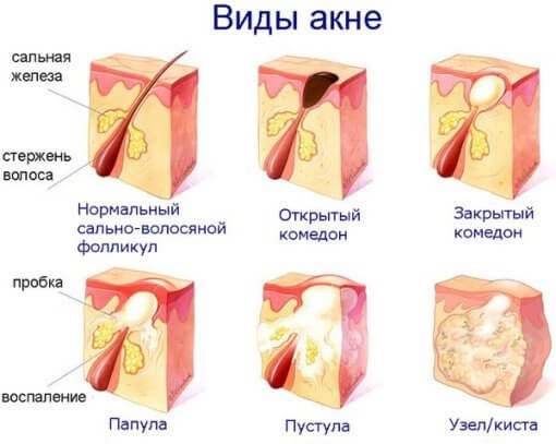 Как избавится от закрытых комедонов в домашних условиях?