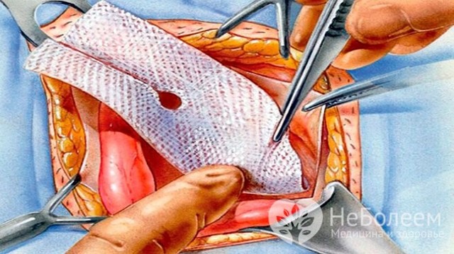 Паховая грыжа: симптомы, причины и варианты лечения
