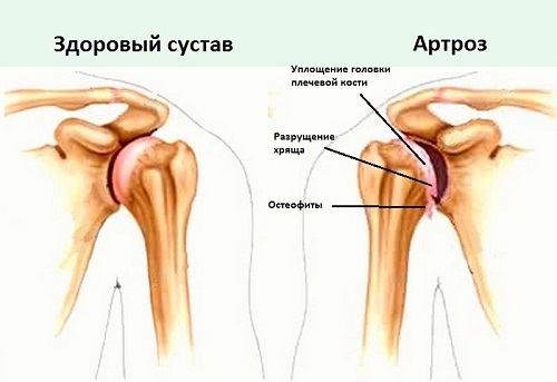Артроз плечевого сустава: симптомы и схема лечения