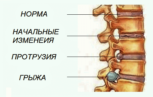 Грыжа поясничного отдела позвоночника: симптомы и лечение