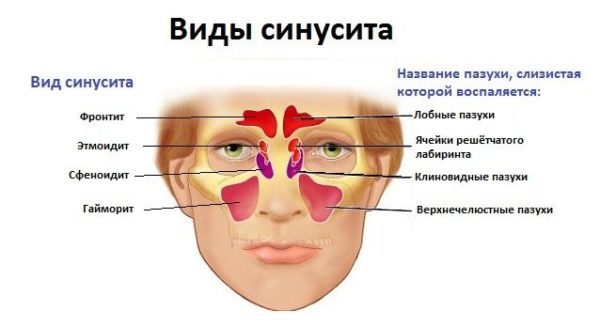 Синусит у взрослых: симптомы и схема лечения на дому