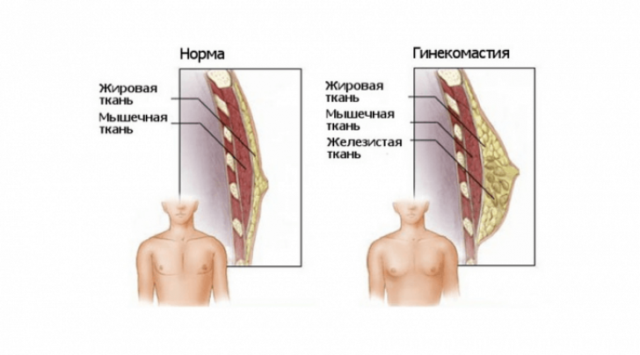 Гинекомастия у мужчин, что это такое и как лечить?