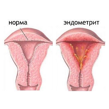 Эндометрит: причины, симптомы и способы лечения