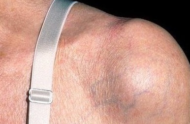 Как выглядит бурсит плечевого сустава, его первые симптомы и варианты лечения