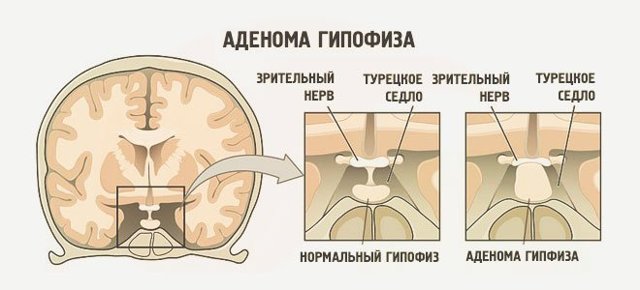 Аденома гипофиза: симптомы у женщин, лечение и прогноз