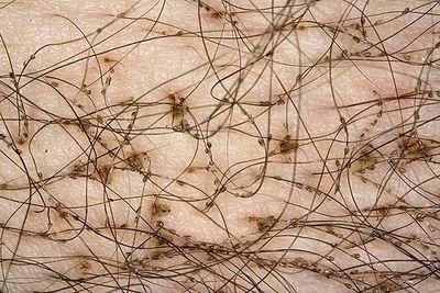 Педикулез, что это такое? Лечение и меры профилактики
