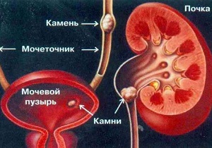 Как лечить камни в мочевом пузыре