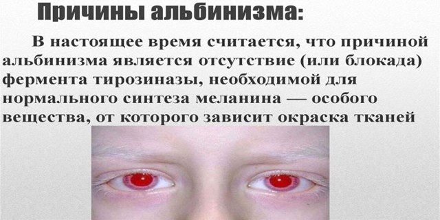 Альбинизм у человека: признаки, причины и лечение