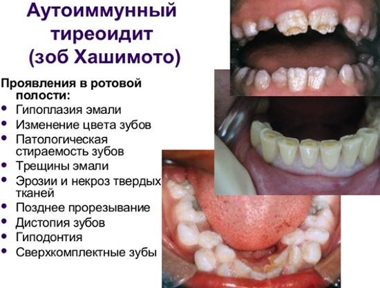Аутоиммунный тиреоидит щитовидной железы