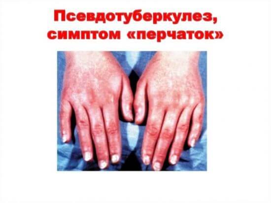 Иерсиниоз: что это такое? Симптомы и способы лечения