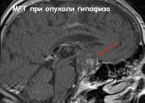 Аденома гипофиза: симптомы у женщин, лечение и прогноз