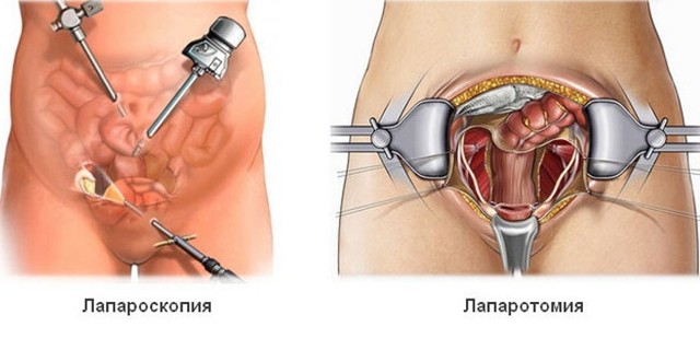 Апоплексия яичника: первые симптомы, причины и варианты лечения