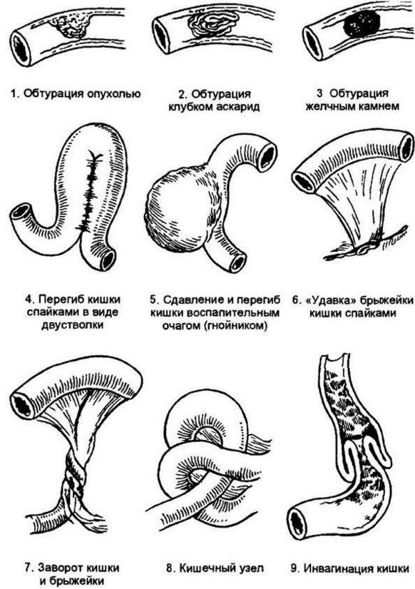 Что делать при кишечной непроходимости?