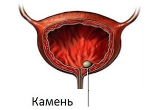 Как лечить камни в мочевом пузыре