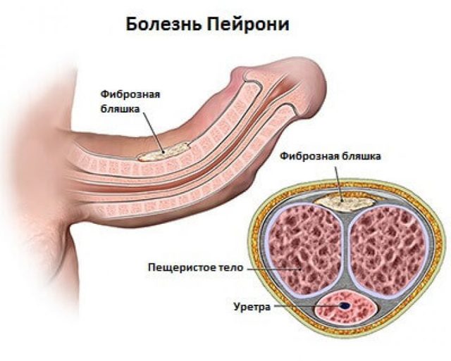 Лечение болезни Пейрони у мужчин, причины и первые симптомы