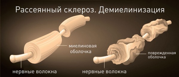 Рассеянный склероз, что это такое? Симптомы, лечение и продолжительность жизни