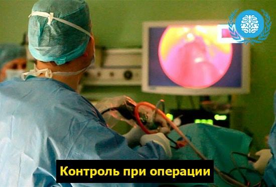 Симптомы и лечение менингиомы головного мозга — прогноз и последствия после удаления опухоли