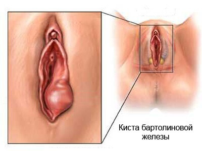 Как лечить кисту бартолиновой железы