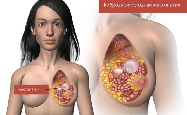 Как лечить диффузно фиброзно-кистозную мастопатию