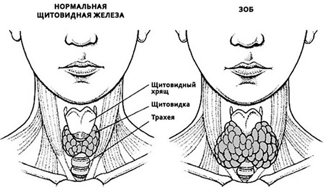 Узловой зоб, что это такое? Как лечить и какие симптомы