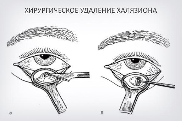 Что такое халязион: симптомы и лечение