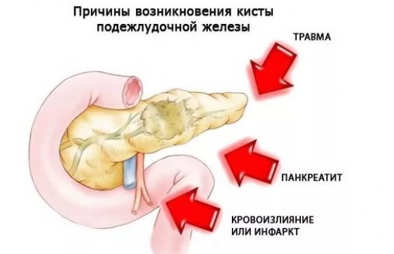 Киста поджелудочной железы: симптомы, причины и лечение