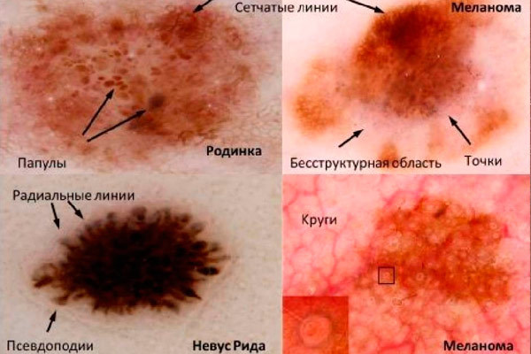 Симптомы меланомы (фото), лечение и прогноз