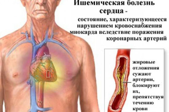 Что такое ишемическая болезнь сердца и чем ее лечить?