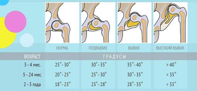 Дисплазия тазобедренных суставов у новорожденных детей (грудничков)