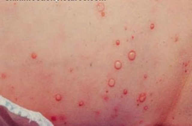 Сепсис у взрослых: симптомы и лечение