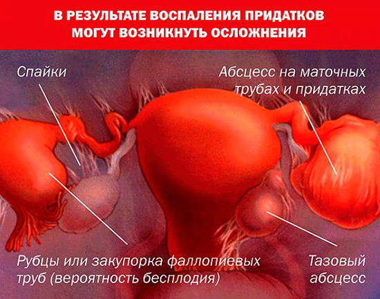 Симптомы воспаления придатков, лечение и профилактика