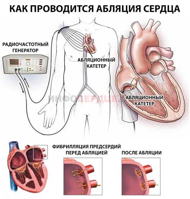Желудочковая экстрасистолия, что это такое? Лечение и последствия