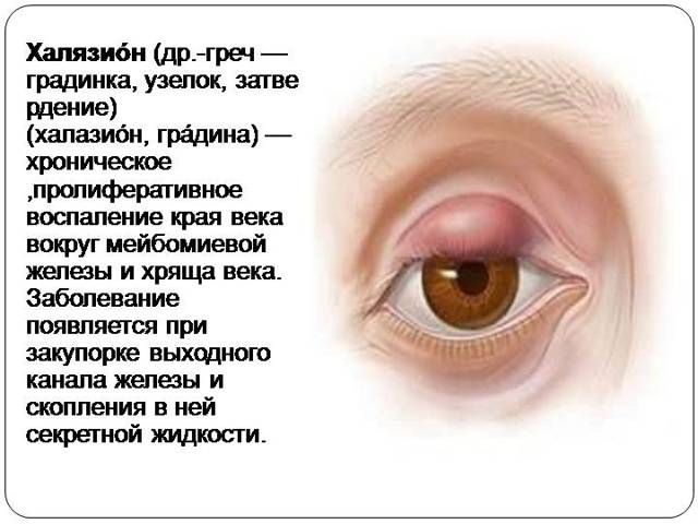 Что такое халязион: симптомы и лечение