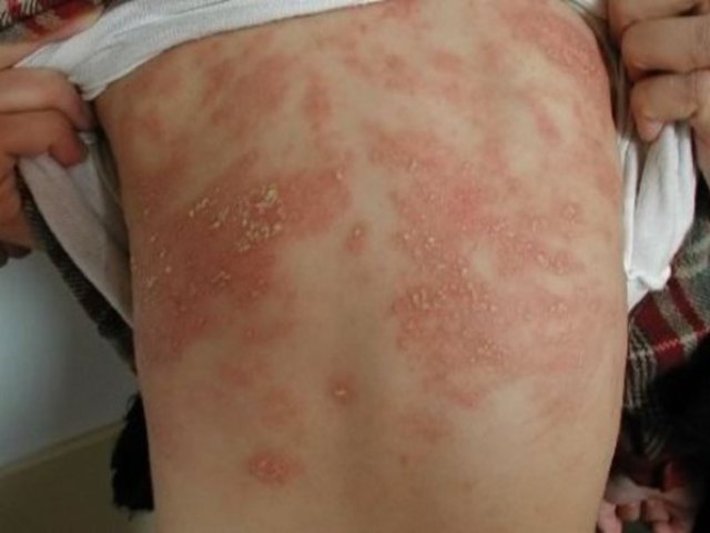 Солнечный дерматит у взрослых и детей: симптомы и способы лечения