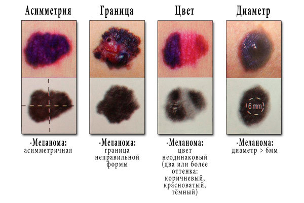 Симптомы меланомы (фото), лечение и прогноз