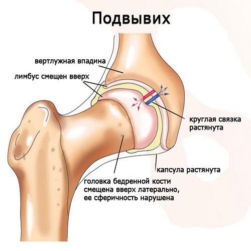 Дисплазия тазобедренных суставов у новорожденных детей (грудничков)