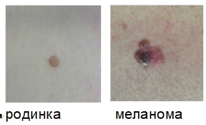 Симптомы меланомы (фото), лечение и прогноз
