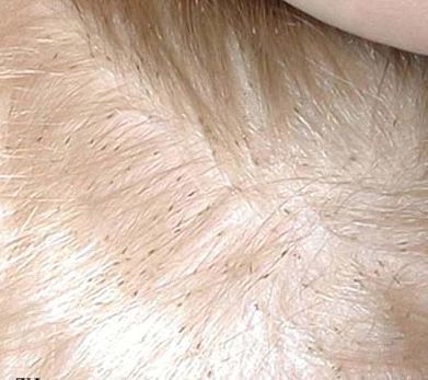 Педикулез, что это такое? Лечение и меры профилактики