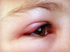 Блефарит: что это такое? Фото, симптомы и лечение