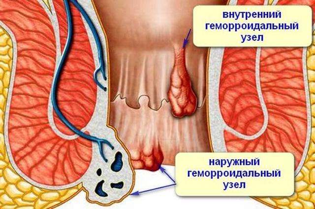 Наружный геморрой: симптомы, фото и способы лечения