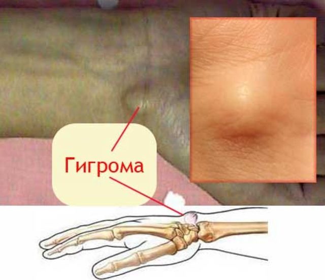 Гигрома: что это такое? Фото, симптомы и лечение