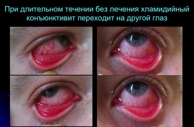 Симптомы конъюнктивита у взрослых, лечение и меры профилактики