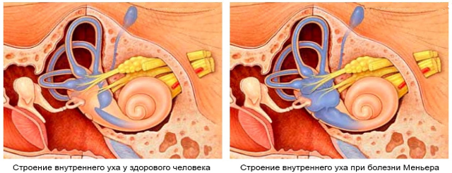 Болезнь Меньера: что это такое? Симптомы и лечение