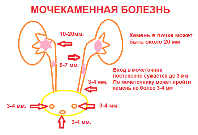 Мочекаменная болезнь: симптомы и способы лечения в домашних условиях