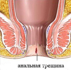 Лечение анальной трещины, симптомы и причины возникновения