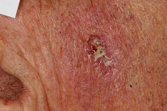 Базалиома: что это такое? Фото, причины и способы лечения базалиомы на коже