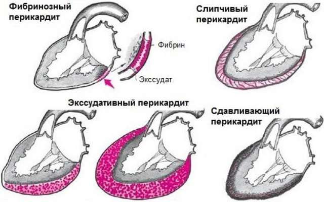Перикардит, что это такое? Причины и способы лечения
