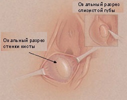 Как лечить кисту бартолиновой железы