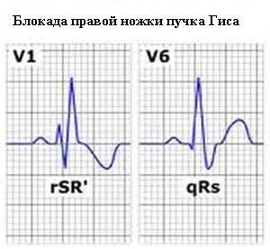 Блокада ножек пучка гиса: что это такое, чем опасно такое состояние?