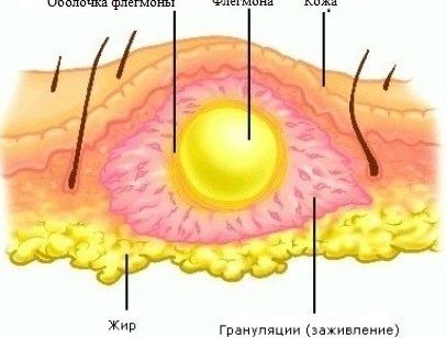 Особенности флегмоны, методы ее лечения и профилактика